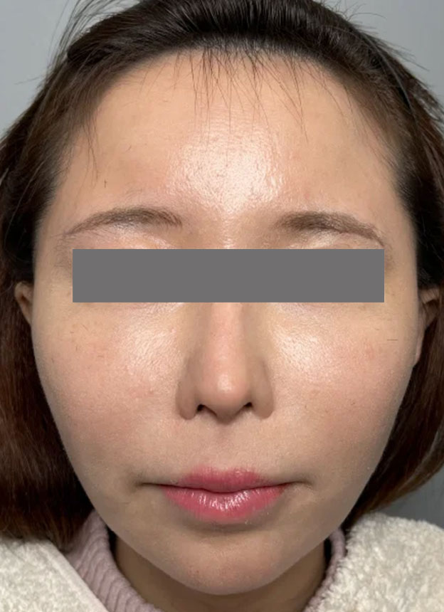 頬をふっくら・脂肪注入,頬に脂肪注入を行ってコケた印象を改善した症例写真,3ヶ月後,mainpic_faceshibo006d.jpg