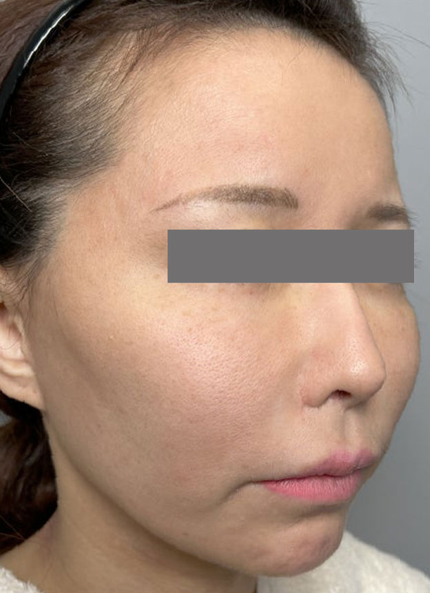 頬をふっくら・脂肪注入,頬に脂肪注入を行ってコケた印象を改善した症例写真,施術前,mainpic_faceshibo006e.jpg
