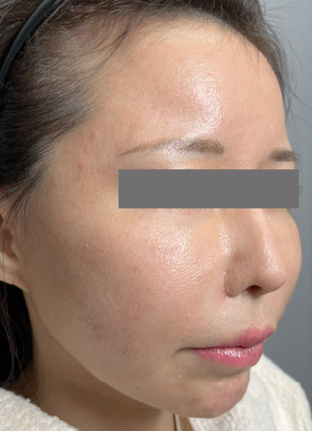 頬をふっくら・脂肪注入,頬に脂肪注入を行ってコケた印象を改善した症例写真,1週間後,mainpic_faceshibo006f.jpg