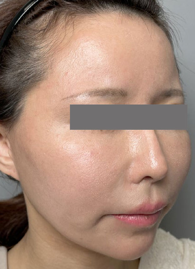 頬をふっくら・脂肪注入,頬に脂肪注入を行ってコケた印象を改善した症例写真,1ヶ月後,mainpic_faceshibo006g.jpg