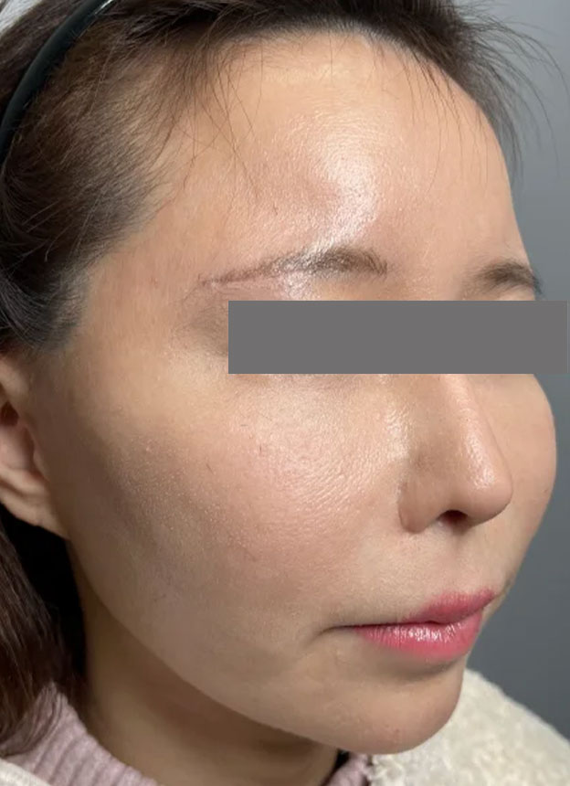頬をふっくら・脂肪注入,頬に脂肪注入を行ってコケた印象を改善した症例写真,3ヶ月後,mainpic_faceshibo006h.jpg