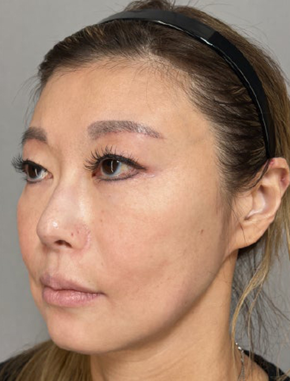 症例写真,たるみが気になりはじめた40代女性にミニフェイスリフトを行った症例写真,Before,ba_minilift029_b02.jpg