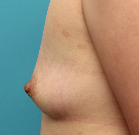 陥没乳頭,30代女性の重度陥没乳頭を手術で改善させた症例写真,After（6ヶ月後）,ba_kanbotsu007_b03.jpg