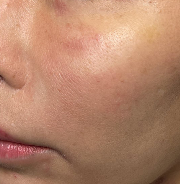 症例写真,ジュベルックで毛穴やキメを改善した症例写真,1週間後,mainpic_juvelook001g.jpg