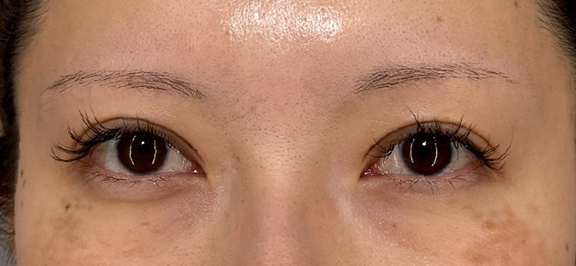 二重まぶた・全切開法,二重まぶた・全切開法でまつ毛のキワがしっかり見えるようにした症例写真,After（1ヶ月後）,ba_sekkai115_a01.jpg