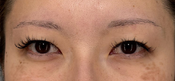 二重まぶた・全切開法,二重まぶた・全切開法でまつ毛のキワがしっかり見えるようにした症例写真,Before,ba_sekkai115_b01.jpg