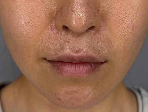 上口唇リフト（人中短縮、リップリフト）の症例写真,After（1年後）,ba_hanashita015_a01.jpg