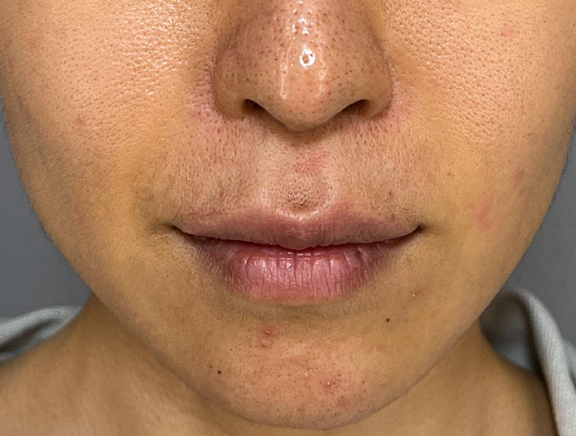 上口唇リフト（人中短縮、リップリフト）の症例写真,Before,ba_hanashita015_b01.jpg