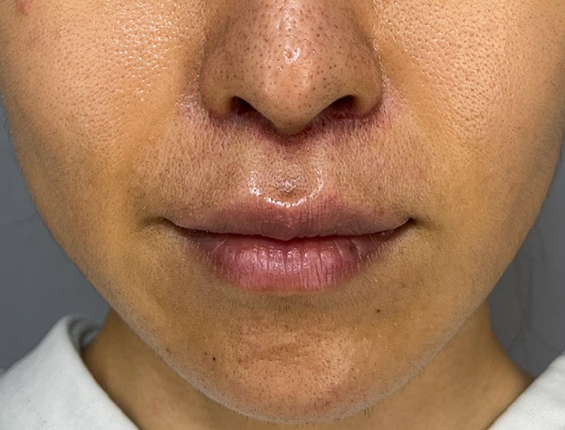 症例写真,上口唇リフト（人中短縮、リップリフト）の症例写真,1週間後,mainpic_hanashita015b.jpg
