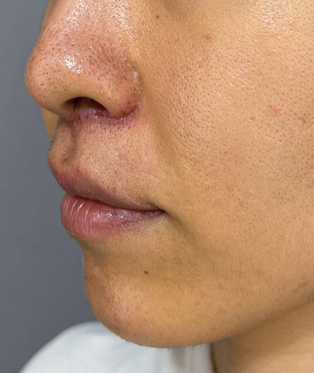 症例写真,上口唇リフト（人中短縮、リップリフト）の症例写真,1週間後,mainpic_hanashita015e.jpg
