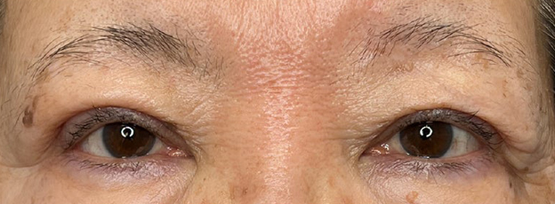 症例写真,眼瞼下垂手術で末広型の二重を作り目を開きやすくした症例写真,3ヶ月後,mainpic_ganken053d.jpg