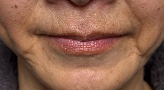 症例写真,下唇を薄くした60代女性の症例写真,After（口を閉じた状態）<br/>
（3ヶ月後）,ba_usuku030_b02.jpg