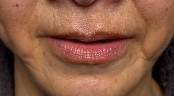 症例写真,下唇を薄くした60代女性の症例写真,After（口を開けた状態）<br/>
（3ヶ月後）,