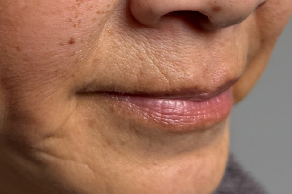 症例写真,下唇を薄くした60代女性の症例写真,After（3ヶ月後）,ba_usuku030_b03.jpg