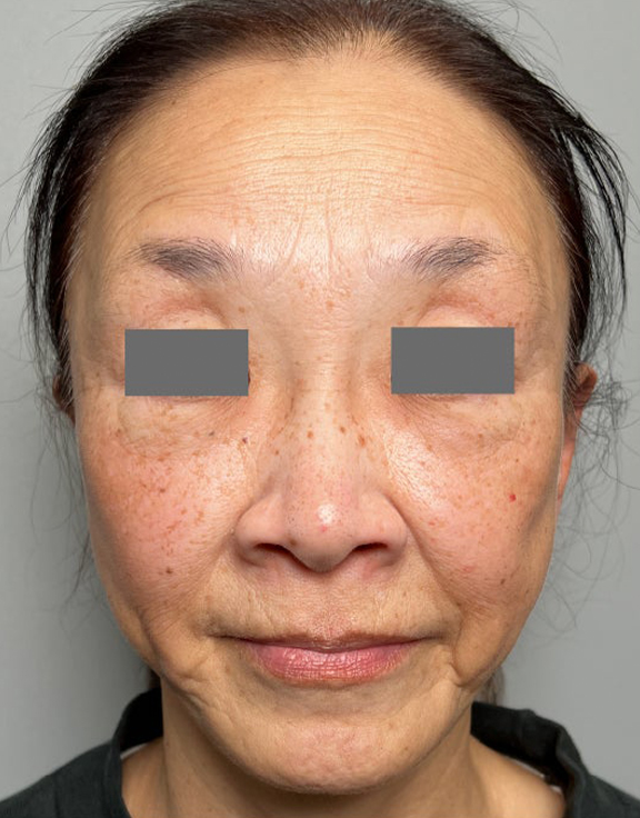 下唇を薄くした60代女性の症例写真,Before,ba_usuku030_b01.jpg