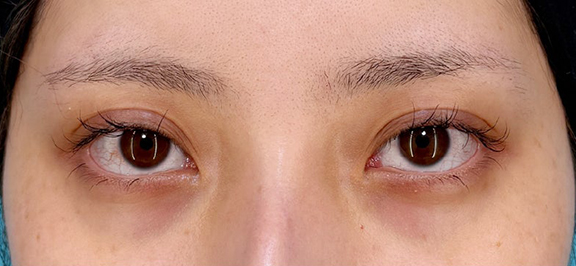 二重まぶた・全切開法,少し幅広めの二重ライン切開手術の症例写真,After（3ヶ月後）,ba_sekkai116_a01.jpg