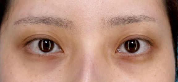 二重まぶた・全切開法,少し幅広めの二重ライン切開手術の症例写真,Before,ba_sekkai116_b01.jpg
