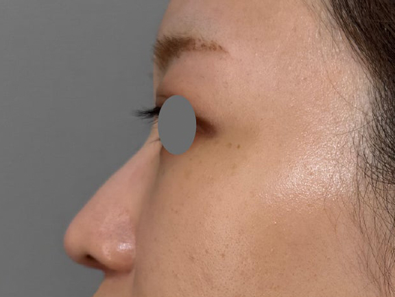 鼻尖の高さを変えずに鼻柱を前方に出した耳介軟骨移植の症例写真,After（3ヶ月後）,ba_jikai059_a01.jpg