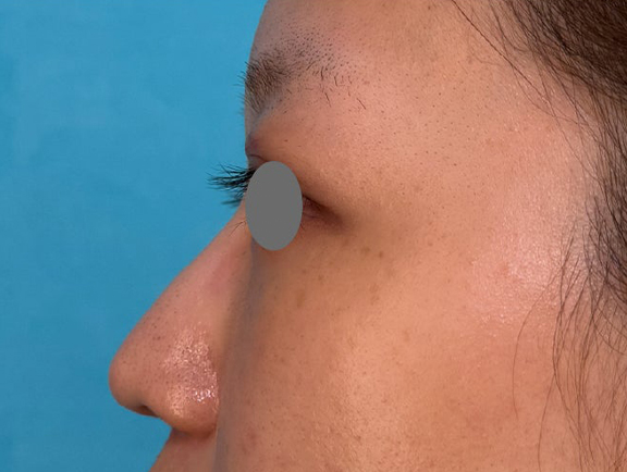 鼻尖の高さを変えずに鼻柱を前方に出した耳介軟骨移植の症例写真,Before,ba_jikai059_b01.jpg