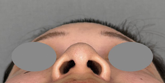 症例写真,小鼻の広がりに対して内側法で鼻翼縮小を行った症例写真,After（3ヶ月後）,ba_biyoku063_b02.jpg