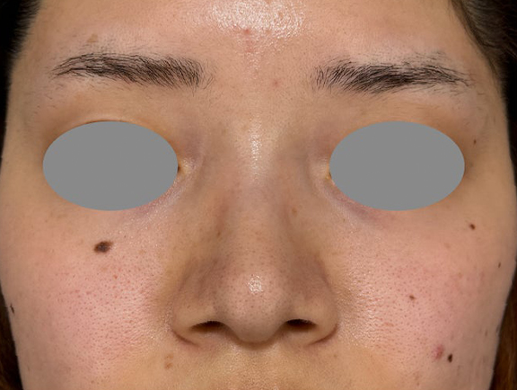 小鼻の広がりに対して内側法で鼻翼縮小を行った症例写真,Before,ba_biyoku063_b01.jpg