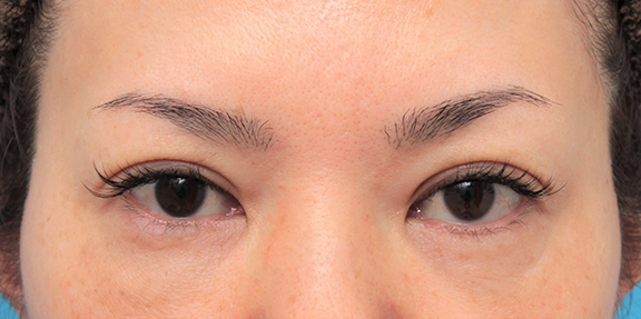 非常に分厚い上まぶたに対してたるみ取り手術を行った40代女性症例写真,After（6ヶ月後）,ba_tarumi016_a01.jpg