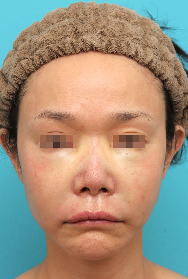 症例写真,鼻翼基部プロテーゼ（貴族手術）を行った40代女性の症例写真,手術直後,mainpic_biyokukibu002b.jpg