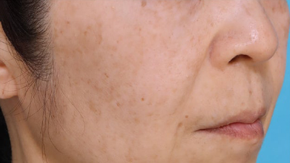 ピコレーザー（PicoWay）,ピコレーザー（PicoWay）でシミ治療をした症例写真,Before,ba_picoway005_b01.jpg