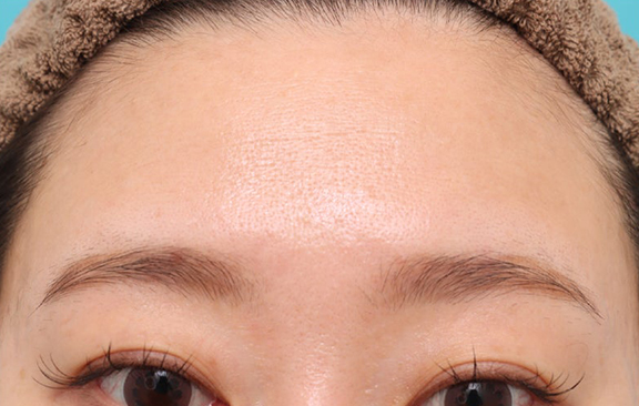 症例写真,キメ細かい滑らかな肌へ導くツヤ肌注射の症例写真,After（1ヶ月後）,ba_tsuyahada003_b03.jpg