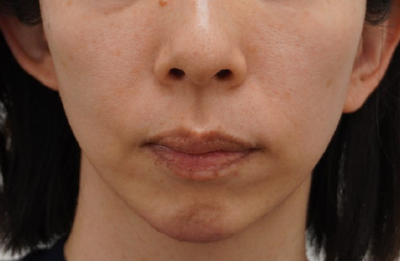 あご注射（ヒアルロン酸）,ミニフェイスリフト（頬のたるみ取り）,脂肪吸引を行わずにたるみを引き締めるミニフェイスリフトの症例写真,After（10ヶ月後）,ba_minilift030_a01.jpg