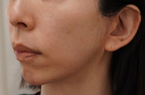症例写真,脂肪吸引を行わずにたるみを引き締めるミニフェイスリフトの症例写真,After（10ヶ月後）,ba_minilift030_b02.jpg