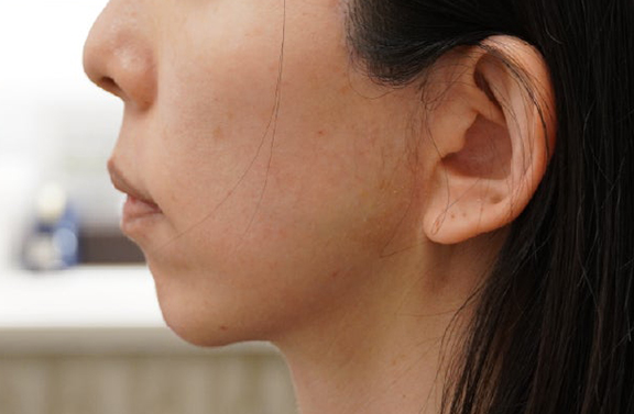 症例写真,脂肪吸引を行わずにたるみを引き締めるミニフェイスリフトの症例写真,After（10ヶ月後）,ba_minilift030_b03.jpg