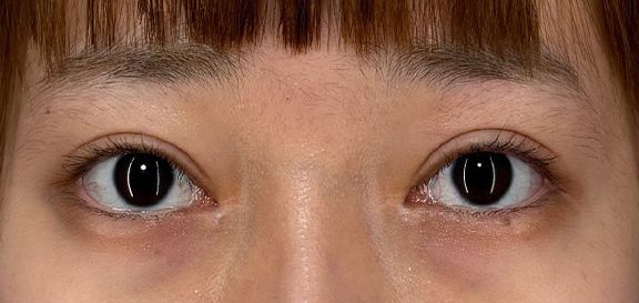 症例写真,目を大きくしたい、まつ毛の生え際を見せたいというご希望の患者様に二重全切開・目頭切開を行った症例写真,After（3ヶ月後）,ba_sekkai117_b01.jpg