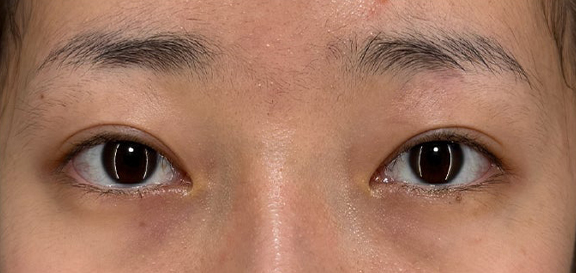 症例写真,目を大きくしたい、まつ毛の生え際を見せたいというご希望の患者様に二重全切開・目頭切開を行った症例写真,Before,ba_sekkai117_b01.jpg