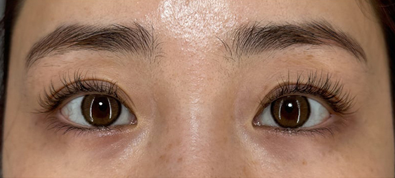 症例写真,当日からメイクができる裏留め埋没法で二重の幅を広げた症例写真,After（2週間後）,ba_maibotsu2014_b01.jpg