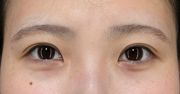症例写真,二重まぶた･埋没法（一針固定）で自然な二重を作った症例写真,After（1ヶ月後）,ba_maibotsu094_b01.jpg