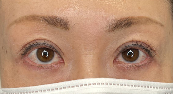症例写真,上まぶたのたるみ取りで二重のラインも整えた症例写真,After（メイクなし）<br/>
（3ヶ月後）,ba_tarumi020_b01.jpg