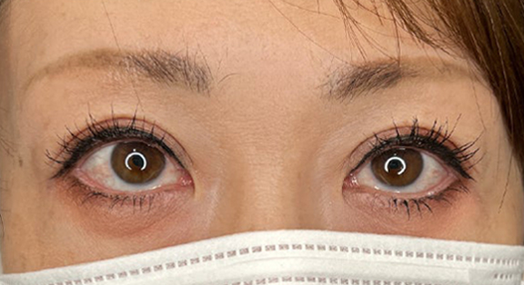 症例写真,上まぶたのたるみ取りで二重のラインも整えた症例写真,After（メイクあり）<br/>
（3ヶ月後）,