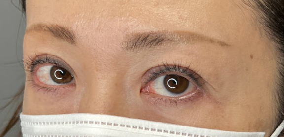 症例写真,上まぶたのたるみ取りで二重のラインも整えた症例写真,After（3ヶ月後）,ba_tarumi020_b02.jpg