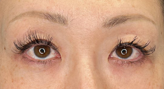 症例写真,上まぶたのたるみ取りで二重のラインも整えた症例写真,Before,ba_tarumi020_b01.jpg