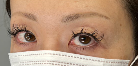 症例写真,上まぶたのたるみ取りで二重のラインも整えた症例写真,Before,ba_tarumi020_b02.jpg
