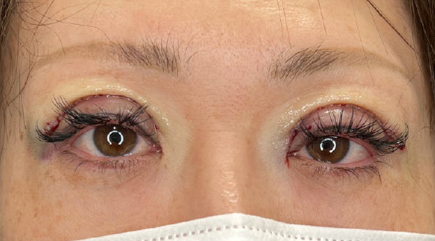 症例写真,上まぶたのたるみ取りで二重のラインも整えた症例写真,施術直後,mainpic_tarumi020b.jpg