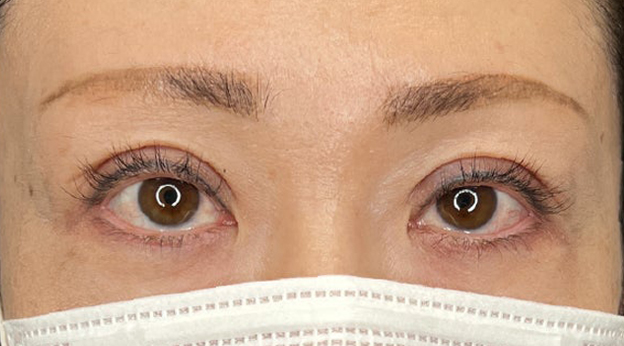 症例写真,上まぶたのたるみ取りで二重のラインも整えた症例写真,1ヶ月後,mainpic_tarumi020c.jpg