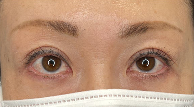症例写真,上まぶたのたるみ取りで二重のラインも整えた症例写真,3ヶ月後,メイクなし,mainpic_tarumi020d.jpg