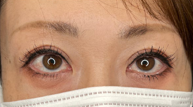 症例写真,上まぶたのたるみ取りで二重のラインも整えた症例写真,3ヶ月後,メイクあり,mainpic_tarumi020e.jpg