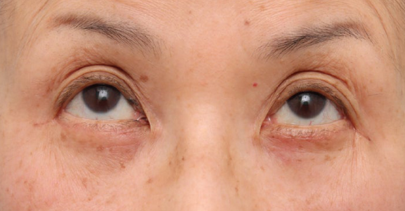 症例写真,目の下のたるみ・黒クマに対して表ハムラ法を行った70代女性の症例写真,After（1ヶ月後）,ba_hamra004_b02.jpg