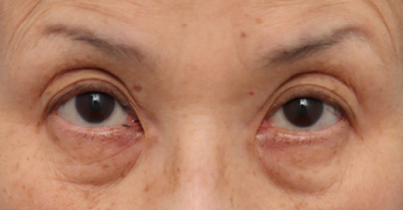 表ハムラ・裏ハムラ法,目の下のたるみ・黒クマに対して表ハムラ法を行った70代女性の症例写真,Before,ba_hamra004_b01.jpg