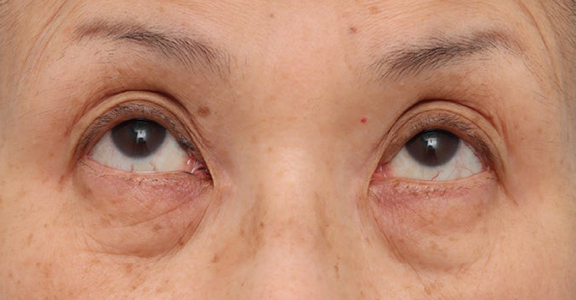 症例写真,目の下のたるみ・黒クマに対して表ハムラ法を行った70代女性の症例写真,Before,ba_hamra004_b02.jpg