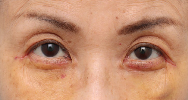症例写真,目の下のたるみ・黒クマに対して表ハムラ法を行った70代女性の症例写真,1週間後,mainpic_hamra004b.jpg