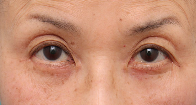 症例写真,目の下のたるみ・黒クマに対して表ハムラ法を行った70代女性の症例写真,1ヶ月後,mainpic_hamra004c.jpg